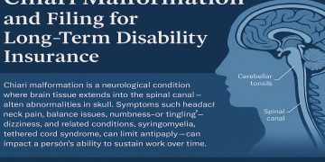 Chiari Malformation Lengthy-Time period Incapacity Claims Information